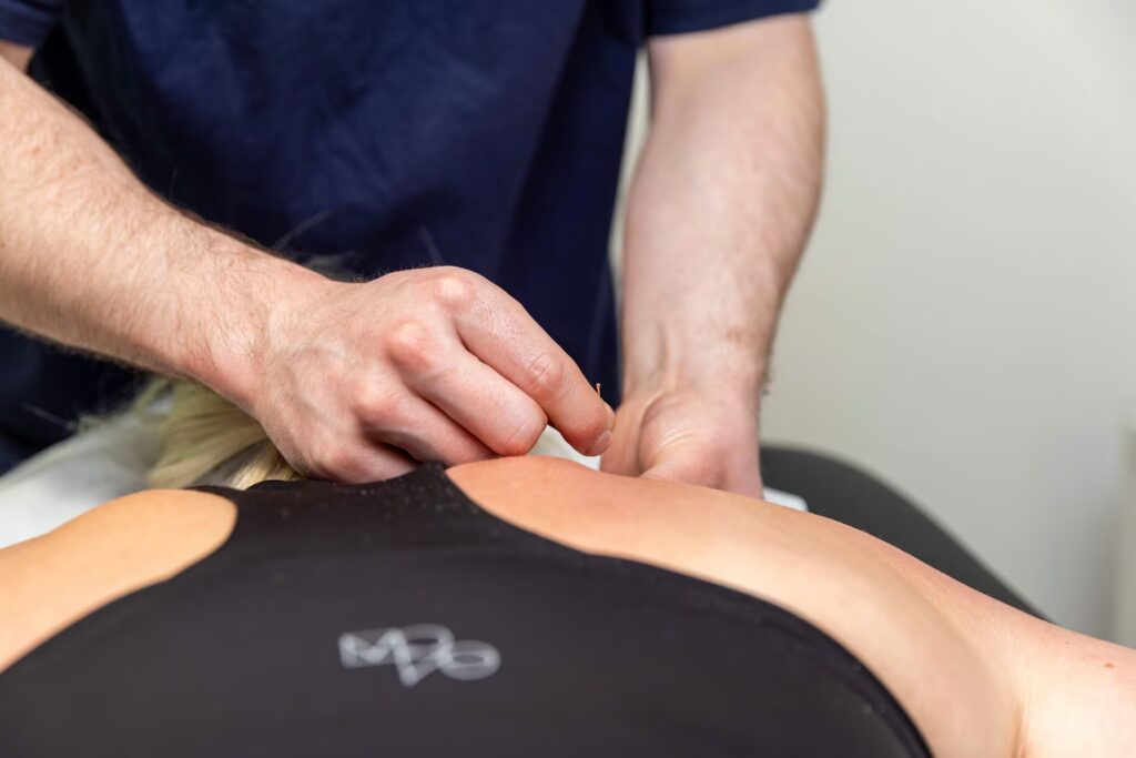 Acupuncture 2 Aberdeen Acupuncture